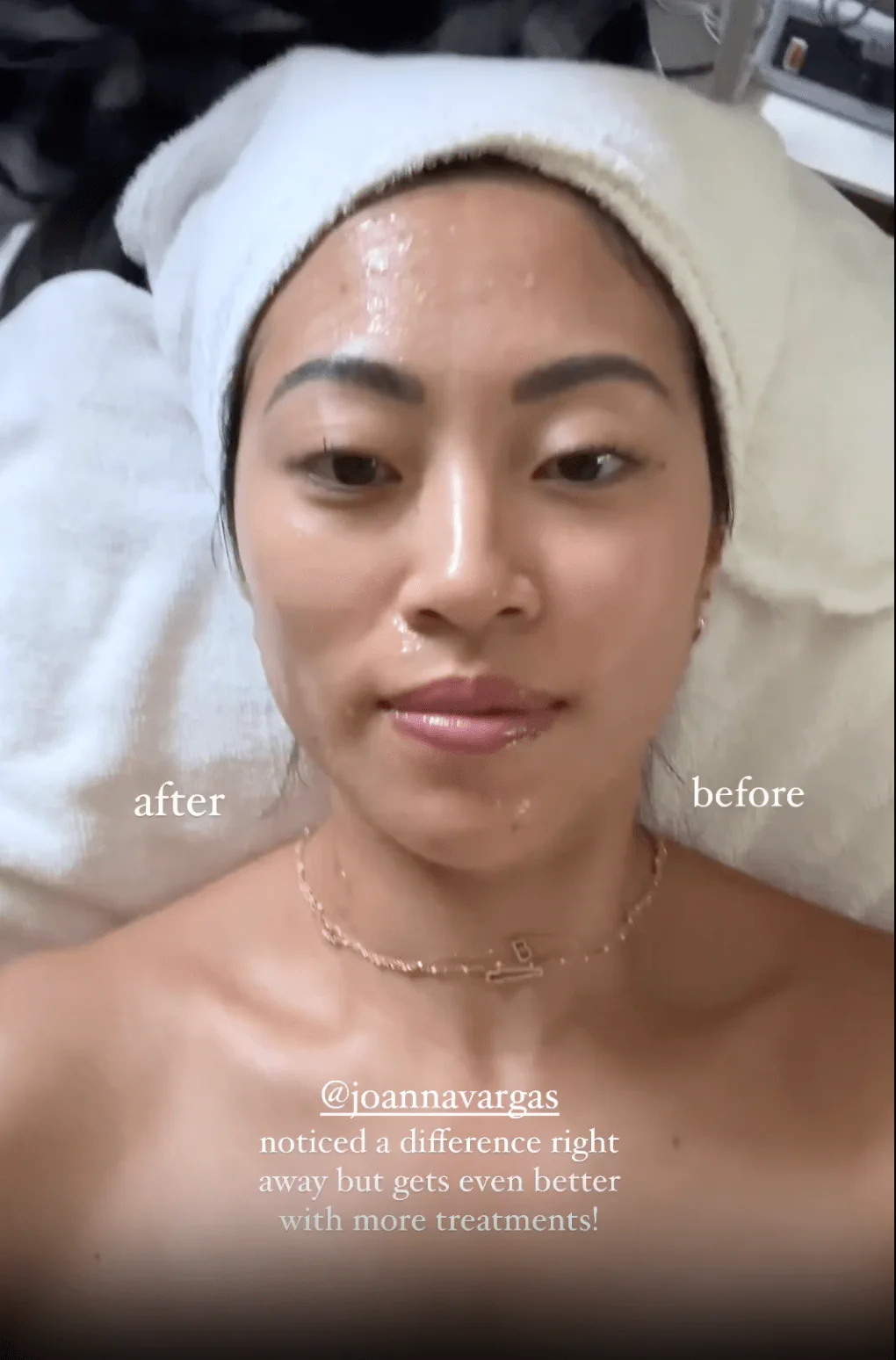 The Rise of Microcurrent Technology in Skincare: A Natural Facelift Revolution - Joanna Vargas