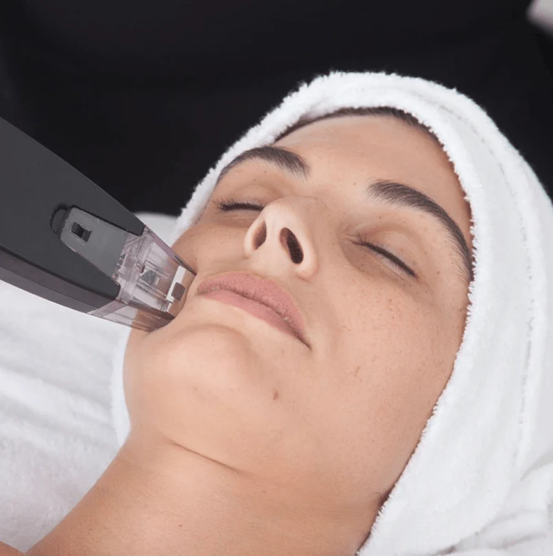 Twilight, our Microneedling RF Facial - Joanna Vargas